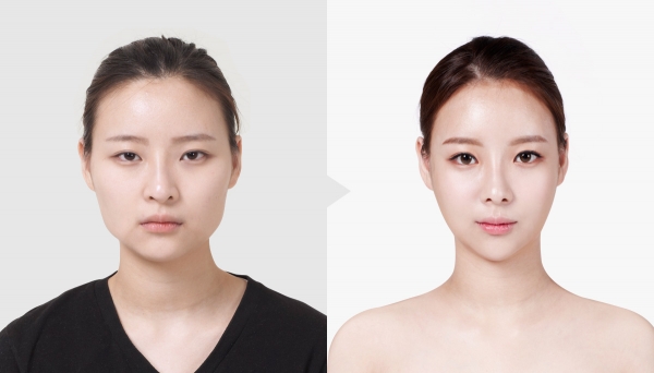 韓國TL整形醫院眼部手術對比案例
